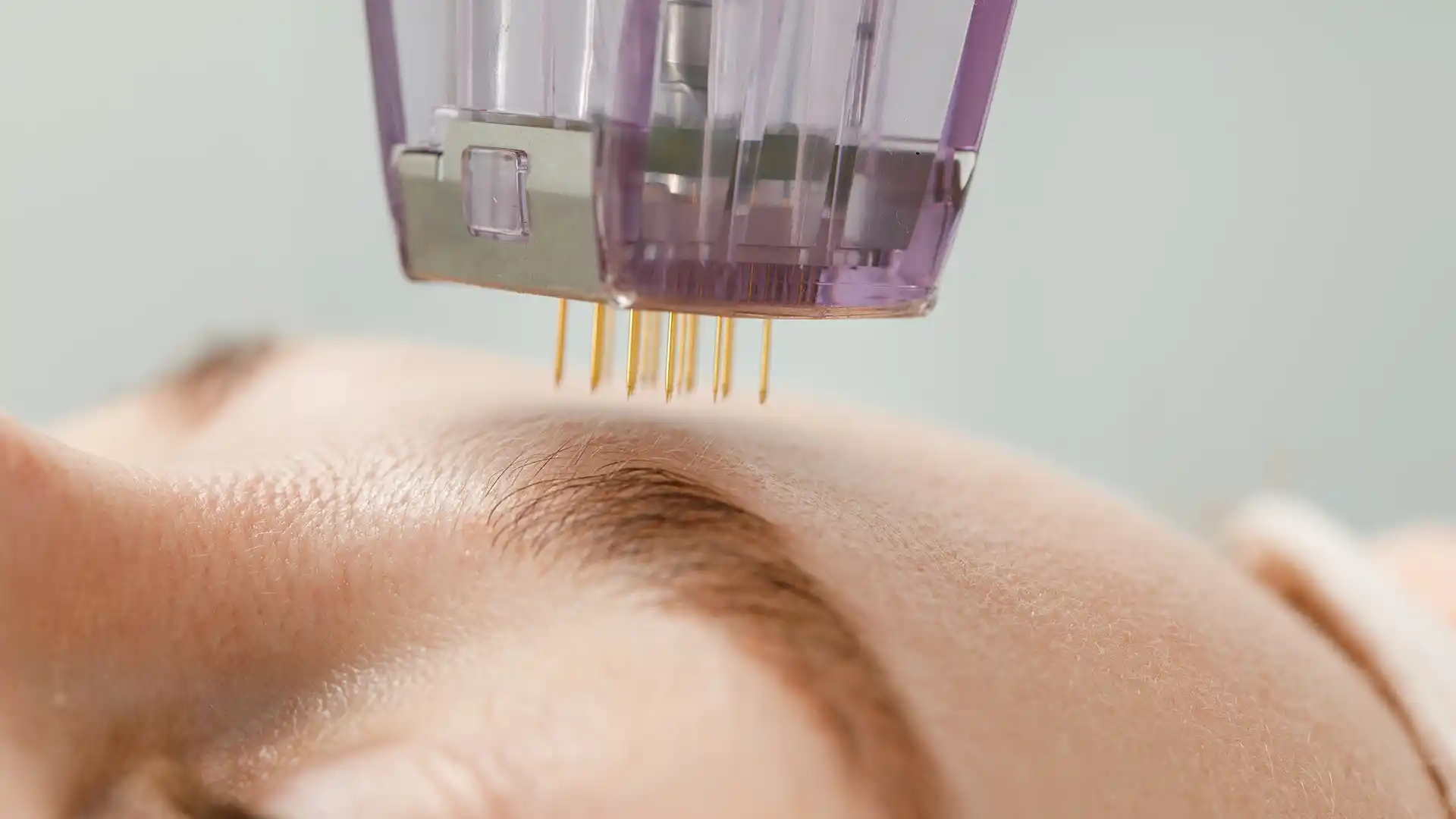 micro-needling montesacro roma